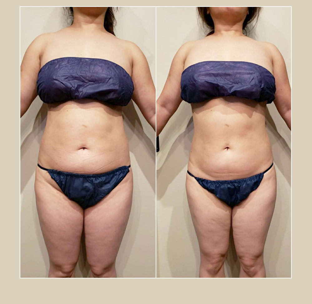 わずか１回でウエスト-4.5cm