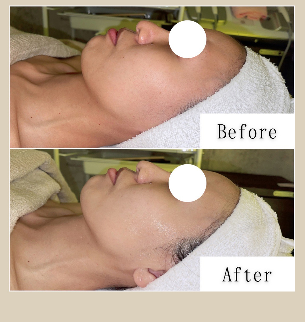 わずか1回20分の施術で顎下のたるみがすっきり解消